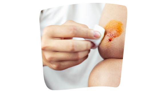 Persona desinfecta una herida con una gasa y un producto antiséptico para evitar infecciones Persona desinfecta una herida con una gasa y un producto antiséptico para evitar infecciones